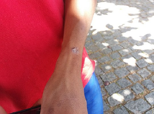 Doença provoca feridas na pele (Foto: Evandro Veiga | Correio) Doença provoca feridas na pele (Foto: Evandro Veiga | Correio)